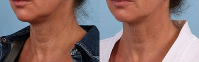 Woman treated with Vivace - Woman treated with Vivace micro needling.