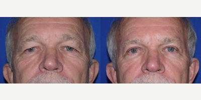 55-64 year old man treated with Brow Lift - 55-64 year old man treated with Brow Lift