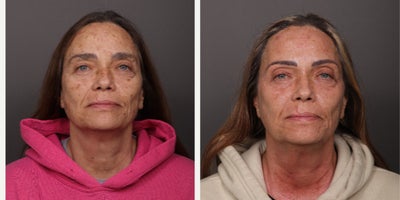 55-64 year old woman treated with Moxi, BroadBand Light (BBL) - BBL HEROic & Moxi Stacked Treatments with Katherine Small. 1 month post treatment. Age 58.