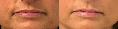 35-44 year old woman treated with Mole Removal - My 42 year old patient 1 week post a mole shaving exicion on her lip.