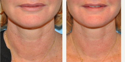 45-54 year old woman treated with ThermiTight - 50 year old female underwent ThermiTight surgery under local anesthesia.
