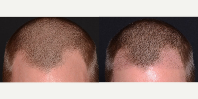 35-44 year old man treated with Hair Transplant - Patient came in wanting to do something about his receding hairline. Dr. Ho recommended the minimally invasive NeoGraft transplant procedure that has little or no discomfort, a quick recovery time, using the patients own hair follicles from the back of the scalp.