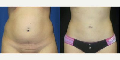 25-34 year old woman treated with Tumescent Liposuction - Woman treated with Tumescent Liposuction of the Back, Abdomen and Flanks. Liposuction was performed on the flanks, back, abdomen.