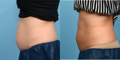 25-34 year old woman treated with Cryolipolysis - 1 session of CoolSculpting for the abdomen.