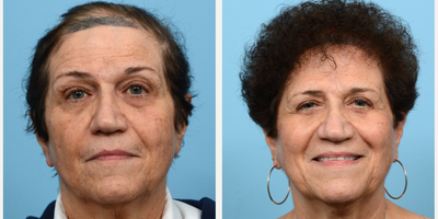 65-74 year old woman treated with Low-Level Laser Therapy - This 71-year-old patient was experiencing a lot of hair loss in addition to thinning on the sides and crown. To fill in these areas and add density overall, Dr. Wise performed an FUT hair transplant using 2,030 grafts, during which she also underwent one session of PRP.