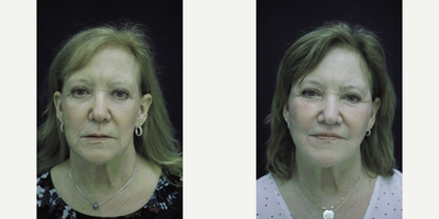 Woman treated with Facial Fat Transfer - Facial Fat transfer