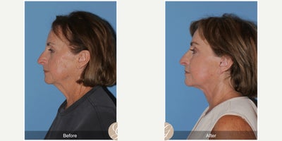 74 year old woman treated with Deep Plane Facelift, Neck Lift, Brow Lift, Lip Lift, MACS Facelift, Facelift - 74 year old woman treated with Deep Plane Face and Neck Lift, Endoscopic Brow Lift, Lip Lift, Full Anterior Face Laser, Fat Grafting, MAC