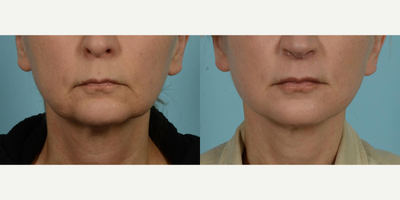 45-54 year old woman treated with Facelift, Lower Facelift, Neck Lift, Facial Fat Transfer, Laser Resurfacing, Dermabrasion - The 54-year-old female patient pictured above was driven by considerable changes of aging, particularly evident in the areas around the jowls and cheeks, thin lips, the early appearance of vertical lines around the mouth, and changes in her neck. This active runner and yoga enthusiast sought out the exceptional Facelift/Minilift by Dr. Mustoe in Chicago, renowned for delivering natural and not overstretched results. The patient was referred by a friend who ten years prior had trusted Dr. Mustoe with a similar surgery.Under IV sedation and local anesthesia, Dr. Mustoe employed a deep plane facelift, fat grafting around the mouth, ablative laser, and spot dermabrasion around the mouth and to her forehead. Her ease throughout the process was likely a result of the widely recognized expertise and care of Dr. Mustoe and his staff at TLKM Plastic Surgery.Post-procedure, the patient's results were dramatically visible in her naturally rejuvenated and fresh appearance. The transformation was balanced, avoiding the appearance of being overstretched, which was crucial for her. Comfort and satisfaction with the Facelift/Minilift by Dr. Mustoe in Chicago was evident in the patient's glowing post-procedure expression, all while retaining the natural characteristics that made her unique. The outcomes bear witness to Dr. Mustoe's excellence, a culmination of over 30 years of experience combined with a prestigious background of education and research from Harvard to advisory positions with the U.S. Food & Drug Administration.
