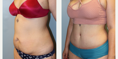 35-44 year old woman treated with Tummy Tuck - Tummy tuck performed by Dr. Bryson Richards