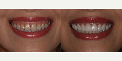 25-34 year old woman treated with Porcelain Veneers, Gum Lift, Teeth Whitening - This patient wanted a transformation before her wedding.  She had gum lift surgery for her gummy smile, followed by porcelain veneers on her upper teeth and KOR whitening on her lower teeth!