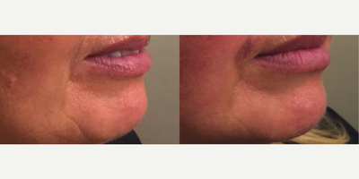 Woman treated with ULTRAcel - Woman treated with ULTRAcel