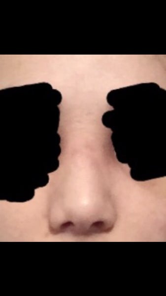 Do I have open roof deformity? (Photo) Doctor Answers, Tips