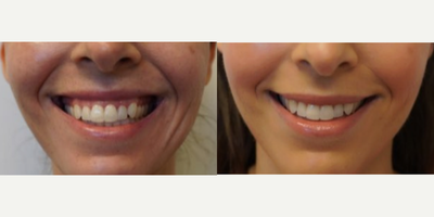 35-44 year old woman treated with Botox for Gummy Smile - This patient received neurotoxin to treat her gummy smile and she had a great outcome. This is a quick and predictable treatment with no downtime! :)