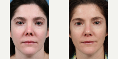 Woman treated with Revision Rhinoplasty - Woman treated with Revision Rhinoplasty for improved nose shape