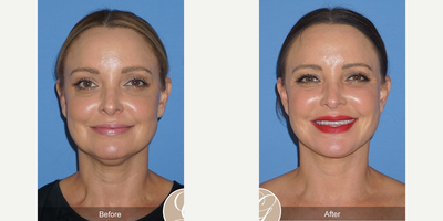 Woman treated with Lower Facelift - Woman treated with Lower Facelift