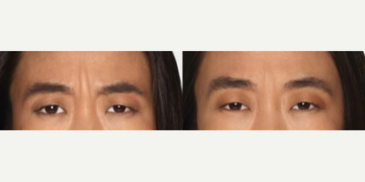 Woman treated with Daxxify - Say goodbye to frown lines with DAXXIFYthe only long-lasting, peptide-powered frown line treatment - DAXXIFY works fast and the results are slow to wear off
