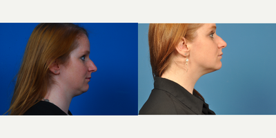 25-34 year old woman treated with Kybella - patient underwent 3 medium round of Kybella, spaced 6 weeks apart.