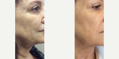 55-64 year old woman treated with Skin Rejuvenation - Treated with laser Skin Rejuvenation.