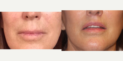 55-64 year old woman treated with Lip Lift - Lip lift