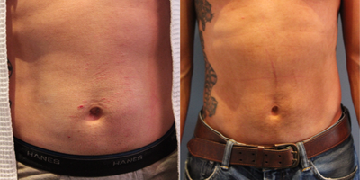45 year old man treated with Velashape - This 45 year old man was treated with VelaShape and UltraShape to improve the appearance of his abdomen. VelaShape is a non-invasive body contouring treatment requiring no downtime.