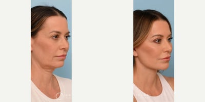 Woman treated with Facelift, Deep Plane Facelift, Neck Lift, Brow Lift, Eyelid Surgery, CO2 Laser - Woman treated with Facelift, Deep Plane Facelift, Neck Lift, Brow Lift, Eyelid Surgery, CO2 Laser