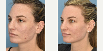 Woman treated with Fraxel Laser - Woman treated with Fraxel Laser.