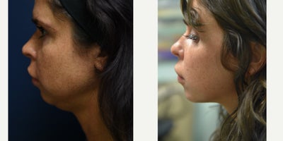 25-34 year old woman treated with Kybella - This patient was unhappy with her profile view, but did not want to undergo surgery. She was treated with Kybella. She underwent two treatments, spaced six weeks apart, for a total of 8 mls of Kybella.&nbsp;