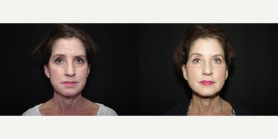 45-54 year old woman treated with Perlane - 54 year old female received1 syringe of Perlane to the infraorbicular, as well as Bellafill and CO2 resurfacing; photo's depict the patient's results 4 months post-op.