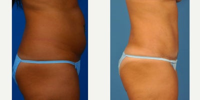 35-44 year old woman treated with Tummy Tuck - Post pregnancy skin excess and fatty deposits resistant to exercise. Goal of wearing a bikini