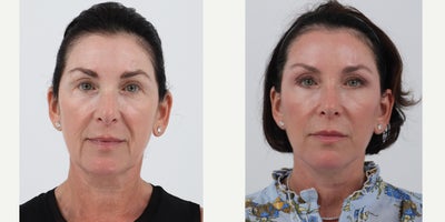 55-64 year old woman treated with Facelift, Neck Lift, Brow Lift, Eyelid Surgery, Facial Fat Transfer, CO2 Laser - 59 years old 8 months after facelift, neck lift, brow lift, upper and lower blepharoplasty, facial fat transfer and co2 laser without general anesthesia.