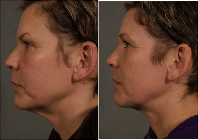 50 year old female after mini neck lift  - Before: 50 year old whos main concern was her neck and jaw line. Also bothered by sun damage and facial wrinkles. Full lower face lift was not an option for this patient due to downtime, not wanting anesthesia, and cost. Was more interested in a mini neck lift.After: 6 months after a mini neck lift (Dr. Rubinsteins T-Lift technique) and laser skin resurfacing using Fraxel Re:pair C02 laser. The mini neck lift targets the neck and not the jaw line. Laser Lift along the jaw line helped give her a more defined jaw line. All incisions are well hidden and invisible. This was all performed under local anesthesia with oral sedation and downtime was about 1 week.