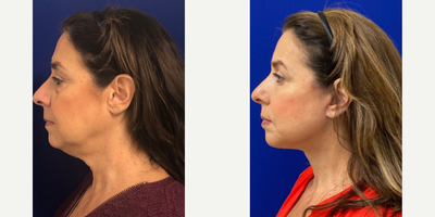 57 year old woman treated with Eyelid Surgery - 57 year old woman treated with Eyelid Surgery through upper and lower blepharoplasty as well as Facelift, Neck Lift, and Facial Fat Transfer, shown 3 months post op.