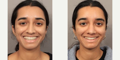 18-24 year old woman treated with Rhinoplasty with an Alarplasty (Nostril Reduction) - Dr. Lexie Wang performed a Rhinoplasty with an Alarplasty (Nostril Reduction). The patient is 4 months post-op.