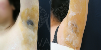 31-year old woman treated with miraDry - This patient suffered from excessive odor and 3 months after treatment, patient saw 80% improvement. Our Miradry patients have reported an average of 70% improvement at one year and 60% to 70% improvement at 2 years with a single treatment. The results are even better with 2nd treatment. We believe that MiraDry has long lasting effect on sweat and odor reduction. We use the starch-iodine test as a guide to help us capture the most active areas of sweating and odor. The iodine stains seen in both pre and post treatment photos shows the sweat glands most active in the underarms. After 1st treatment, the iodine stain shows significant decrease of sweat & odor activity. MiraDry is a non-invasive, non-surgical alternative which has proven to be quite effective in sweat/odor reduction. MiraDry has very minimal risk and complication profile and has shown to be quite effective in our practice for the past 2 year.