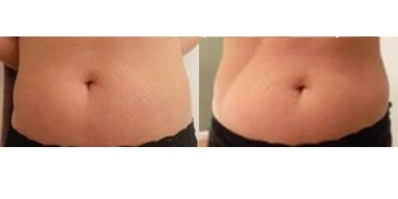 It Works Body Wraps Do They Actually Work Body Wrap Forum