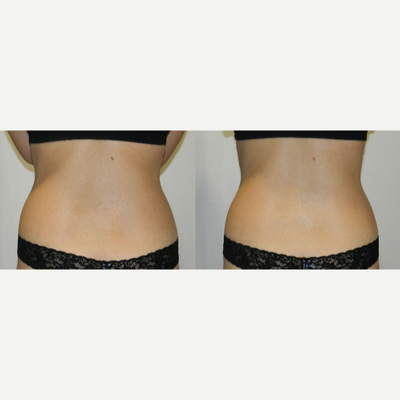 35-44 year old woman treated with i-Lipo - 6 sessions of iLipo plus carboxytherapy