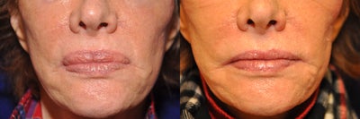 Lip Reduction - Lip Reduction