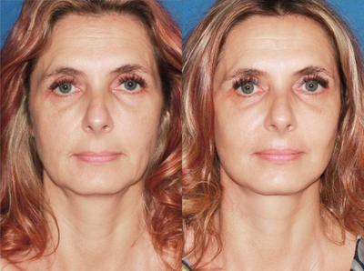 35-44 year old woman treated with Mini Facelift - Patient presented with early aging changes of the face that primarily affected her jawline. A facelift was performed to restore her jawline defenition and rejuvenate the face.