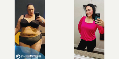 Woman treated with Gastric Sleeve Surgery - Gastric Sleeve Surgery