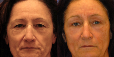 45-54 year old woman treated with Blue Peel - Blue Peel