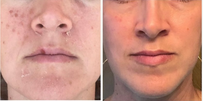 35-44 year old woman treated with Neo Laser and VI Peel - VI Peel & Aerolase Neo used to treat pigmentation, fine lines, acne, and enlarged pores.