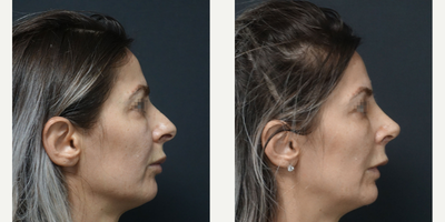 35-44 year old woman treated with Rhinoplasty - Rhinoplasty - 16 days post-op