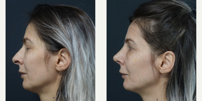35-44 year old woman treated with Rhinoplasty - \\192.168.1.3\Marketing_Workgroup\Will_Be_Share_Ready\Hacer Eren