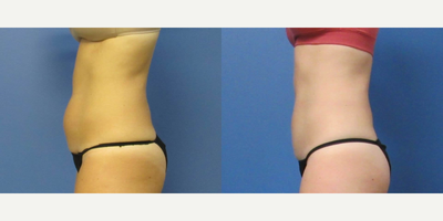 45-54 year old woman treated with CoolSculpting Elite - Patient one month post-op Coolsculpting Elite of the abdomen, flanks and inner thighs.