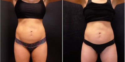 Woman treated with UltraShape Power - 12 weeks post, 3 treatments