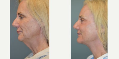 65-74 year old woman treated with Brow Lift, Chin Implant, CO2 Laser, Facelift, Laser Resurfacing, Neck Lift - We rolled out the red carpet for this lovely patient! As we age, our skin loses its fight with gravity and drooping can impact us in different areas, so its not a one-size-fits-all packaging. For this patient, her aging was focused down the center of her face rather than down the jowls, which tends to be most common in women. So for her, Dr Woodman went with a Brow lift to focus on the eyes to brighten and lighten the center focal point, then give her a strong chin before using his signature Deep Plane Facelift technique to set her face and neck lift, aligning her muscular structure flawlessly so her skin is not stretched unnaturally.Typically, our after photos for facelift patients are taken after six months, because as you will see, this patient still has some swelling (the face can take up to twelve months to fully heal!!!), but she is SO pleased with her results she wanted us to show off Dr Woodman's work now.