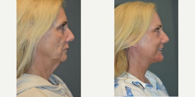 65-74 year old woman treated with Brow Lift, Chin Implant, CO2 Laser, Facelift, Laser Resurfacing, Neck Lift - We rolled out the red carpet for this lovely patient! As we age, our skin loses its fight with gravity and drooping can impact us in different areas, so its not a one-size-fits-all packaging. For this patient, her aging was focused down the center of her face rather than down the jowls, which tends to be most common in women. So for her, Dr Woodman went with a Brow lift to focus on the eyes to brighten and lighten the center focal point, then give her a strong chin before using his signature Deep Plane Facelift technique to set her face and neck lift, aligning her muscular structure flawlessly so her skin is not stretched unnaturally.Typically, our after photos for facelift patients are taken after six months, because as you will see, this patient still has some swelling (the face can take up to twelve months to fully heal!!!), but she is SO pleased with her results she wanted us to show off Dr Woodman's work now.