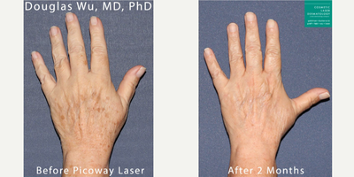 65-74 year old woman treated with PicoWay - PicoWay laser used to remove brown spots and sun damage from the backs of the hands
