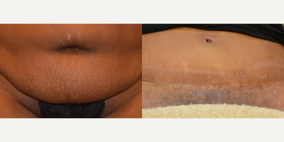 45 year old Tummy Tuck patient treated with Embrace Scar Therapy - This 45 year old patient with a history of Keloid scarring used Embrace Scar Therapy during her healing phase to proactively minimize thickness and discoloration along her incision line. She is seen here immediately after her 3rd embrace treatment was removed.