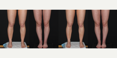 25-34 year old woman treated with Calf Reduction - 27 year old before and six weeks after liposuction to thighs, inner knees, calves and ankles.